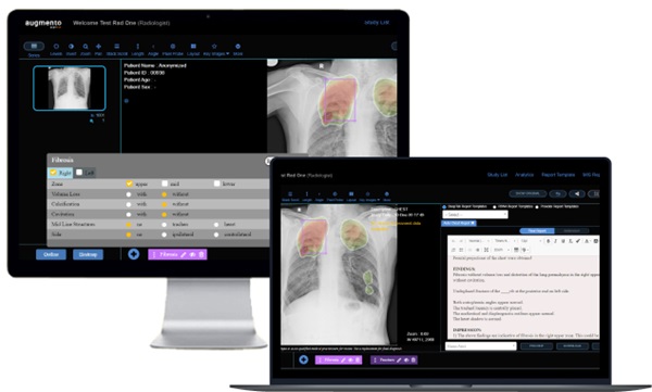 Image: Augmento X-Ray reduces radiologist workload by an impressive 30-50% (Photo courtesy of DeepTek.ai, Inc.)